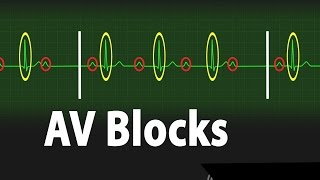 AV Block 1st 2nd and 3rd degree  ECG Interpretation [upl. by Nylatsirk]