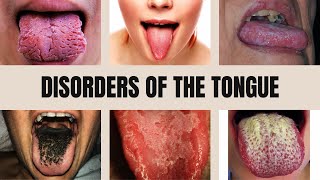 Tongue Diseases Geographic Tongue Black Hairy Tongue Glossitis Thrush and Leukoplakia [upl. by Mord]