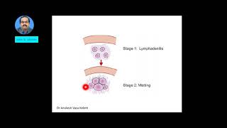 TUBERCULOUS LYMPHADENITIS SCROFULA [upl. by Selie]