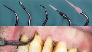 Scaling and root planing also known as conventional periodontal therapy [upl. by Herwick]