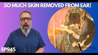 SO MUCH SKIN REMOVED FROM PATIENTS EAR CANAL  EP945 [upl. by Irra]