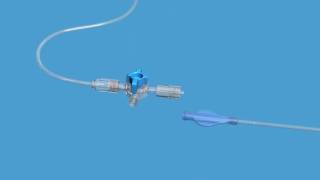 Vertebral Body Stenting [upl. by Brita]