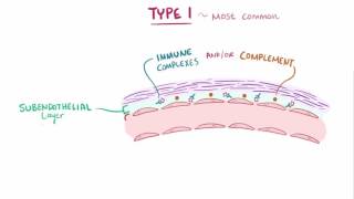 Membranoproliferative glomerulonephritis MPGN causes symptoms amp pathology [upl. by Val]