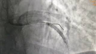 Angioplasty to critical Ostial Left Main Stem to Proximal Lad with 2 DES CABG refused by Patient [upl. by Nickolas]