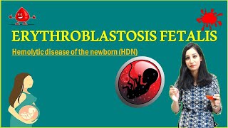 ERYTHROBLASTOSIS FETALIS II Hemolytic disease of the newborn HDN [upl. by Janifer950]