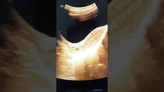 Nabothian cyst in cervix [upl. by Kendall]