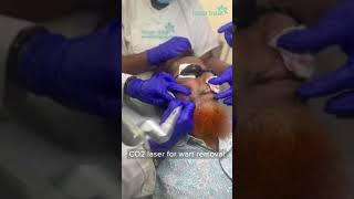 CO2 Laser  Wart Removal  Dhaka Dermatology Institute  LaserTreat [upl. by Nered]