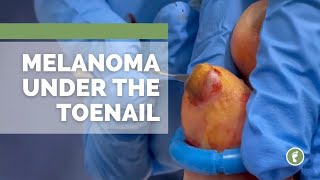 Melanoma UNDER the toenail [upl. by Baylor372]