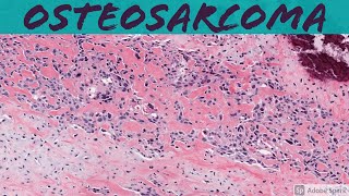 Osteosarcoma 101 Bone Pathology Basics [upl. by Niabi]