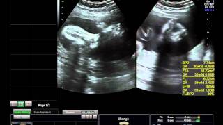 my BABYs Ultrasound at 30 weeks 4days amp baby was Breech [upl. by Wiedmann]