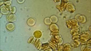 SPIROCHETES  coming out of a WBC [upl. by Kwang]