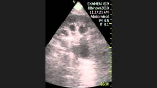 VSCAN Hydronephrosis grade III Pocket Ultrasound Hidronefrosis grado III Eco de bolsillo [upl. by Wilmer669]