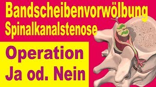 Bandscheibe amp Sianalkanalstenose Operation Ja oder Nein [upl. by Nahsab]