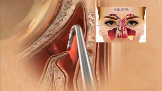 Sinus Surgery 3D Animation  Sinusitis Treatment  Sinus Operation [upl. by Maida]