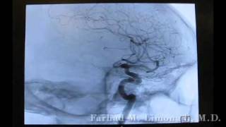 3D Cerebral Angiography [upl. by Evita567]