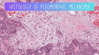 Histology of Pleomorphic adenoma [upl. by Nats]