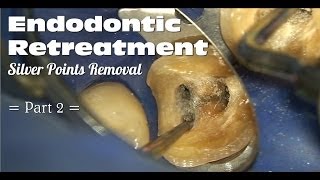 Endodontic Retreatment  Silver Points Removal Part 2 [upl. by Daphna]