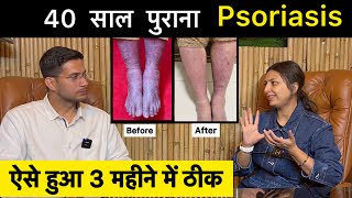 Psoriasis Treatment In Hindi Ft upasanakiduniya  Skin Disease  Himanshu Bhatt [upl. by Renata]