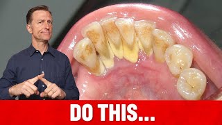 The 1 Top Remedy for Dental Plaque TARTAR [upl. by Enner85]