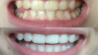 How I whitened my VERY yellow teeth WORKS BEFORE AND AFTER [upl. by Soigroeg486]