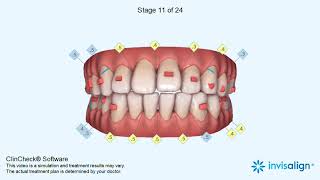 Invisalign ClinCheck® [upl. by Assiluy]