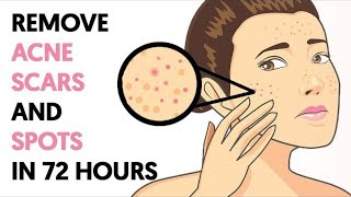 How to Get Rid of Acne Scars and Spots in 72 Hours [upl. by Adnorat]