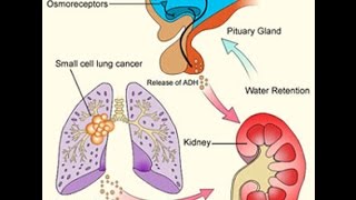 SIADH [upl. by Godrich]