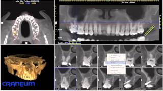 Tutorial CRANEUM iCat Vision  parte1  Tomografia Computadorizada Volumetrica  Cone Beam [upl. by Ahsital]