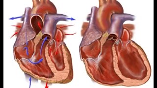 Congestive Heart Failure [upl. by Nadean]