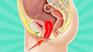 Heart valve disease malayalamMitral valve prolapse malayalam MVP Heart valve leakage malayalam [upl. by Edrei]