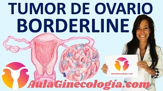 TUMOR DE OVARIO BORDERLINE TIPOS PRONÓSTICO TRATAMIENTO SEGUIMIENTO Ginecología y Obstetricia [upl. by Idnac]