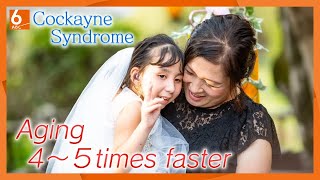 A 14 year old girl in the body of a 4 year old Aging 4 to 5 times faster due to Cockayne Syndrome． [upl. by Ahsinoj]