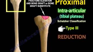 Tibial Plateau Fracture Fixation Proximal Tibia  Everything You Need To Know  Dr Nabil Ebraheim [upl. by Alurta]