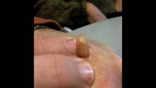 Man Squeezes Botfly from Hand [upl. by Tombaugh]