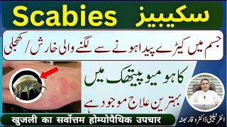 Scabies شدید خارش اور کھجلی शरीर में कीड़ों से खुजली होना Homeopathic Treatment In Urdu  Hindi [upl. by Attenoj]