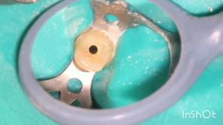 Root canal treatment full step by step [upl. by Ragucci]