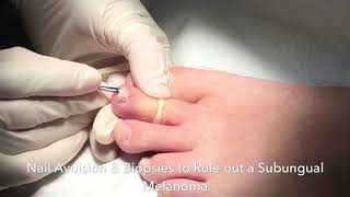 Nail Biopsy to Rule out melanoma under the nail [upl. by Isiahi]