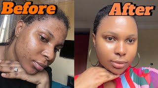 How I cleared my acne using 2 products Every oily skin girlie needs this [upl. by Burbank]