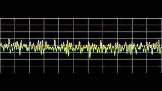 Anxiety Disorders also Phobias  Rife Frequencies [upl. by Marshall]