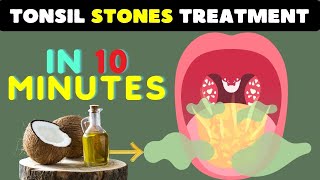 How to Remove Tonsil Stones 10 Powerful Home Remedies for Tonsil Stones Relief [upl. by Cohn818]