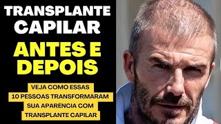 TRANSPLANTE CAPILAR ANTES E DEPOIS 10 PESSOAS QUE MUDARAM INCRIVELMENTE SUA APARÊNCIA [upl. by Daune211]