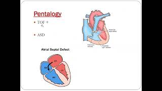 Pentalogy of fallot  Dr Akif Baig [upl. by Eillim942]