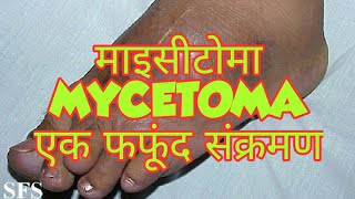 Mycetoma in hindi [upl. by Ivett451]