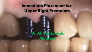 Immediate Implant Placements in Upper Premolars with Sinus Proximity [upl. by Nahgaem]