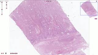 Acute Pyelonephritis  Histopathology [upl. by Bresee174]