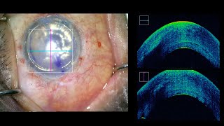 Descemet Stripping Automated Endothelial Keratoplasty DSAEK [upl. by Ylera326]