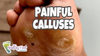 CALLUS REMOVAL AT HOME SO SATISFYING [upl. by Eilyac]