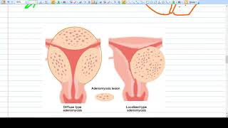 Adenomyosis  Concept  Diagnosis Management [upl. by Vickie919]