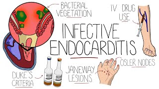 Infective Endocarditis With Duke Criteria amp Pathophysiology [upl. by Casmey86]