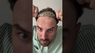 Wait to see my hairline transformation  Lavivid Hair System [upl. by Eido641]